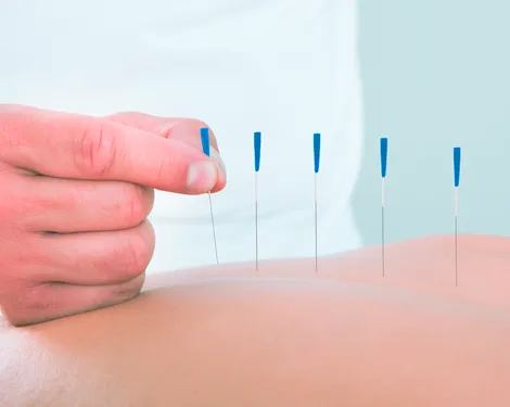 Acupuncture Dry Needling Birmingham